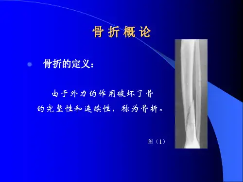 骨折概论1-3