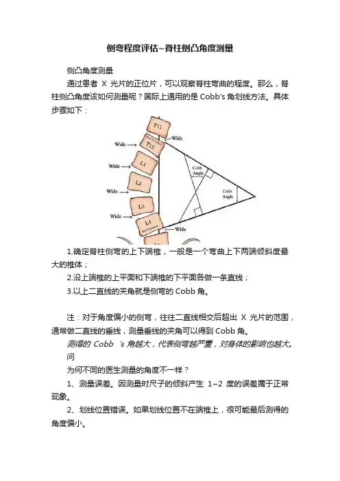 侧弯程度评估~脊柱侧凸角度测量