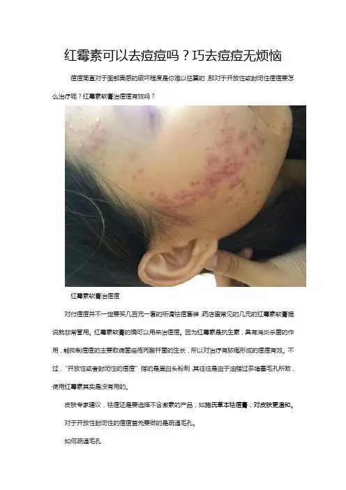 红霉素可以去痘痘吗？巧去痘痘无烦恼