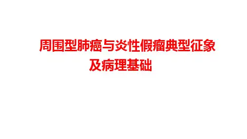 周围型肺癌、炎性假瘤典型影像征象及病理基础