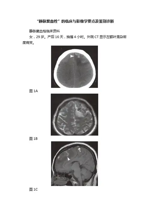 “静脉窦血栓”的临床与影像学要点及鉴别诊断