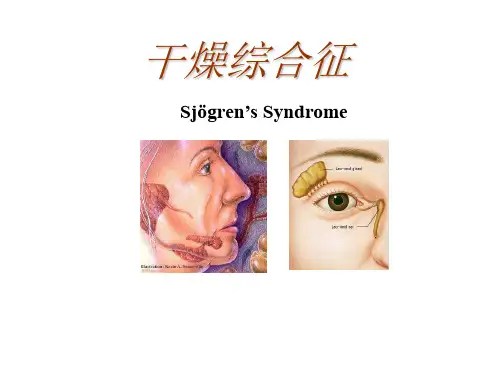 干燥综合征