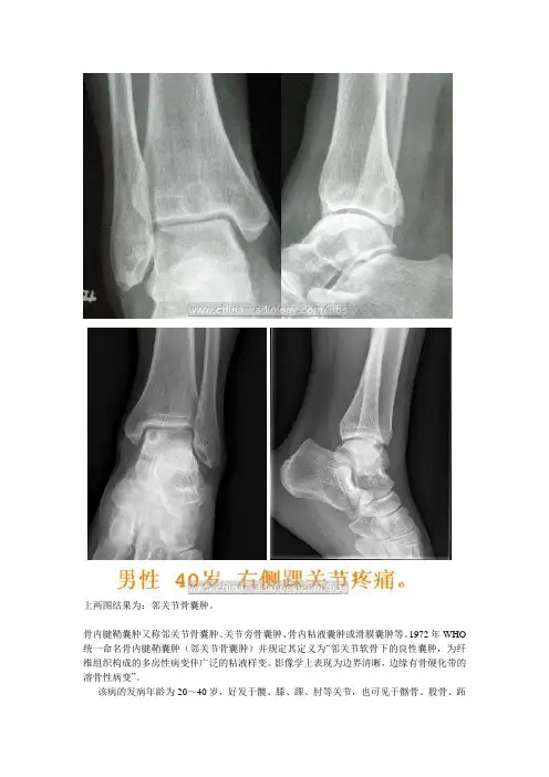 骨内腱鞘囊肿