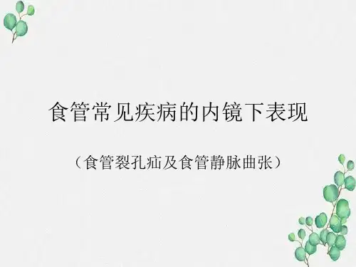 食管裂孔疝及食管静脉曲张的内镜下表现