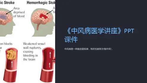 《中风病医学讲座》课件