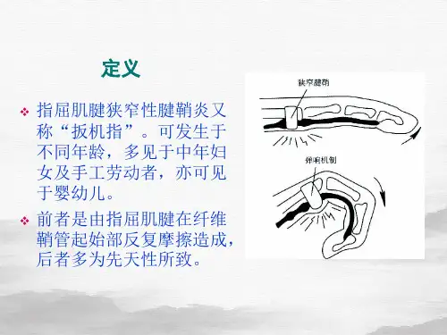 狭窄性腱鞘炎的针刀治疗课件PPT
