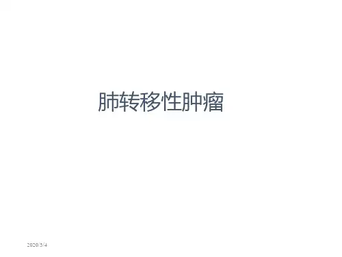 肺转移性肿瘤影像诊断