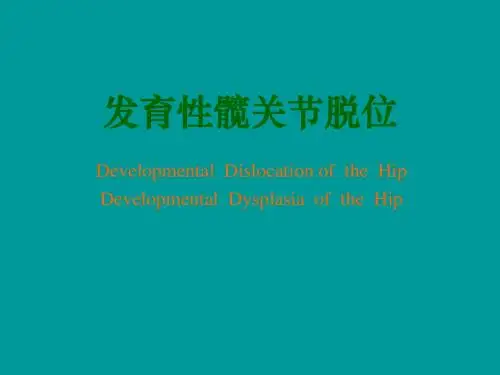 发育性髋关节脱位