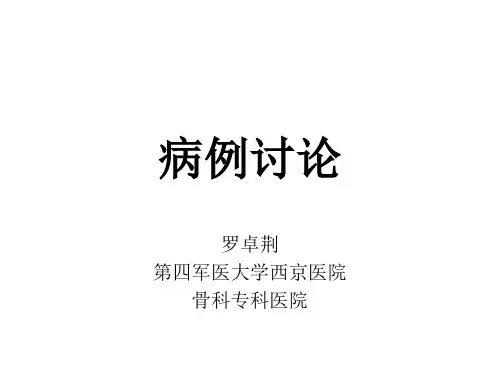 病例讨论—特发性脊柱侧弯