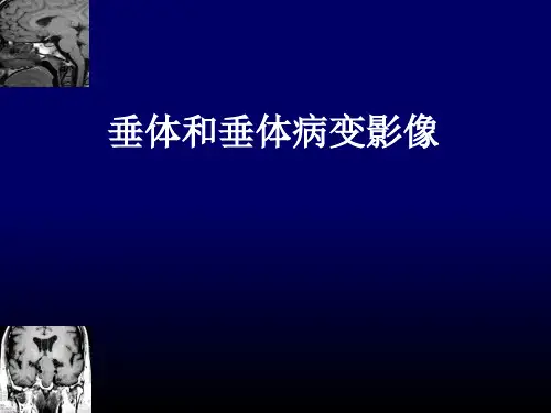 垂体和垂体病变影像
