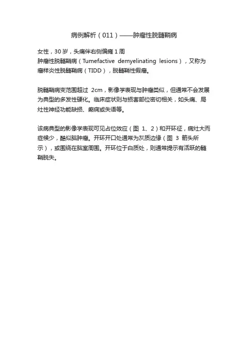 病例解析（011）——肿瘤性脱髓鞘病
