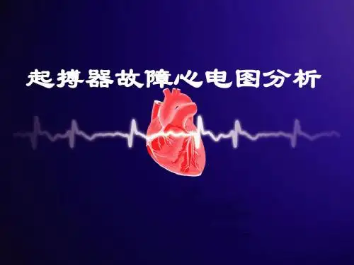 起搏器故障心电图分析