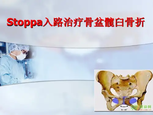 stoppa技术精品课件