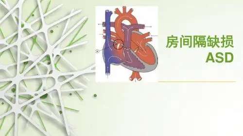 房间隔缺损