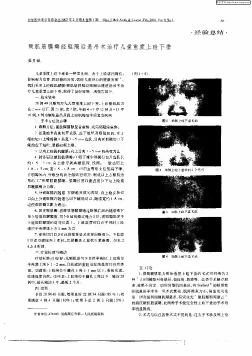 额肌筋膜瓣经眶隔后悬吊术治疗儿童重度上睑下垂