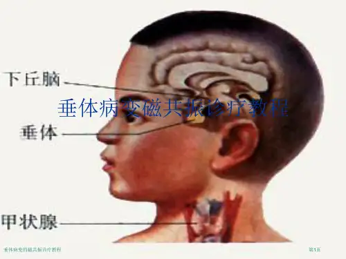 垂体病变的磁共振诊疗教程