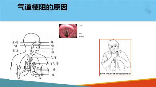 常用急救技术—气道异物梗阻现场救护(护理课件)