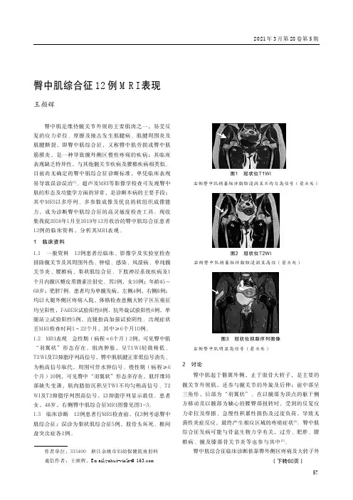 臀中肌综合征12例MRI表现