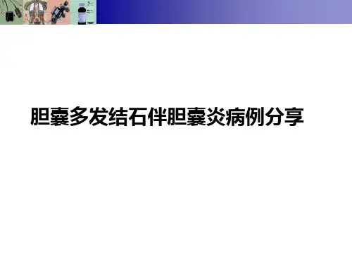 胆囊多发结石伴胆囊炎病例分享ppt课件