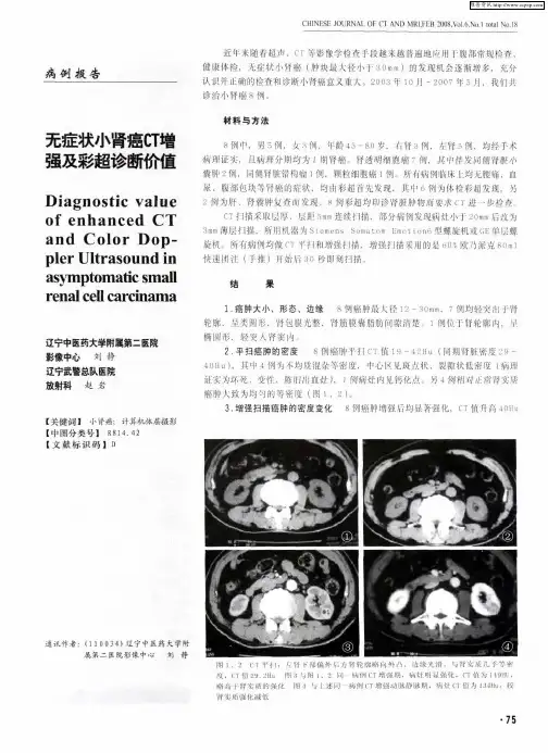无症状小肾癌CT增强及彩超诊断价值