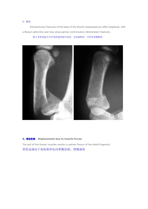 手术-第1掌骨基底(关节外)骨折切开复位内固定术