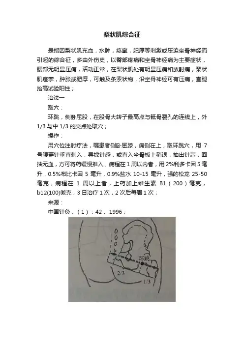 梨状肌综合征