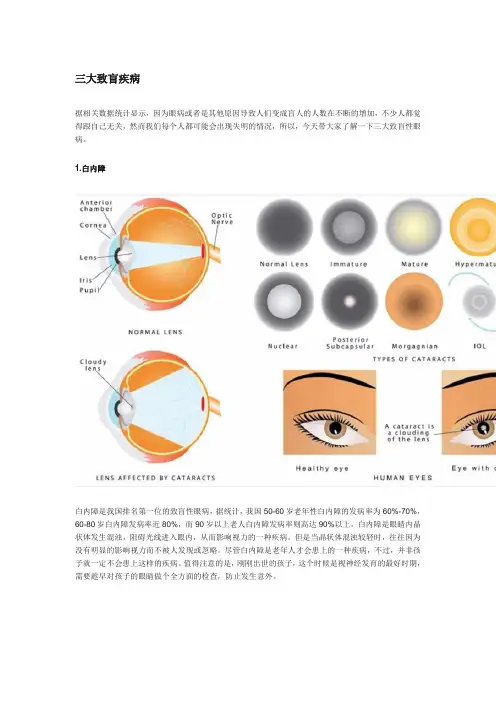 世界三大致盲性眼病,你以为你不会患病？
