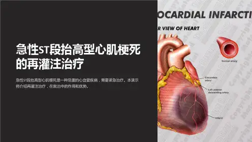 急性ST段抬高型心肌梗死的再灌注治疗