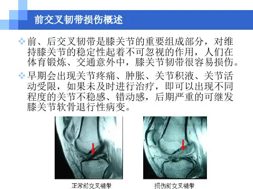 前叉韧带重建术课件