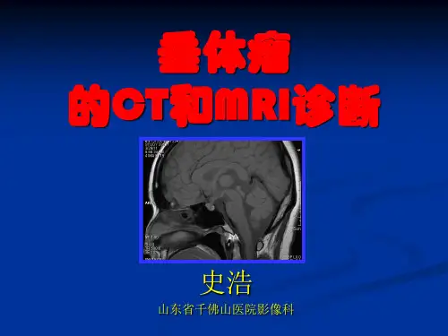 垂体瘤的CT和MRI诊断