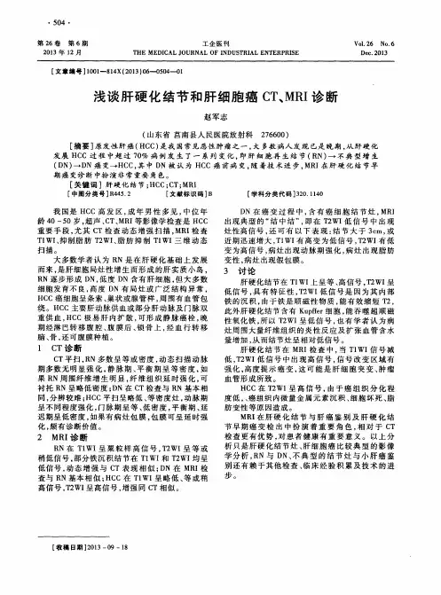 浅谈肝硬化结节和肝细胞癌CT、MRI诊断