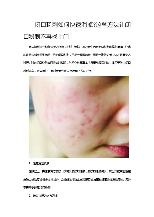 闭口粉刺如何快速消掉_这些方法让闭口粉刺不再找上门
