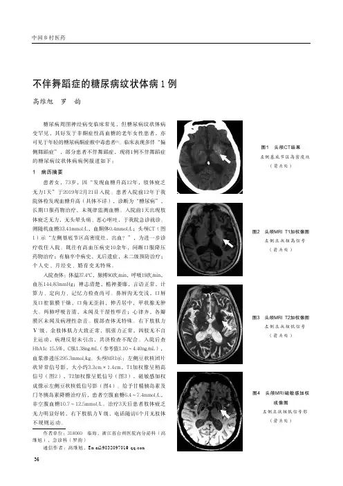 不伴舞蹈症的糖尿病纹状体病1例