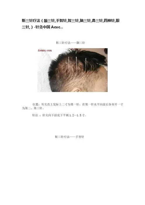 靳三针疗法（颞三针,手智针,智三针,脑三针,鼻三针,四神针,眼三针,）-针灸中国Acuc...