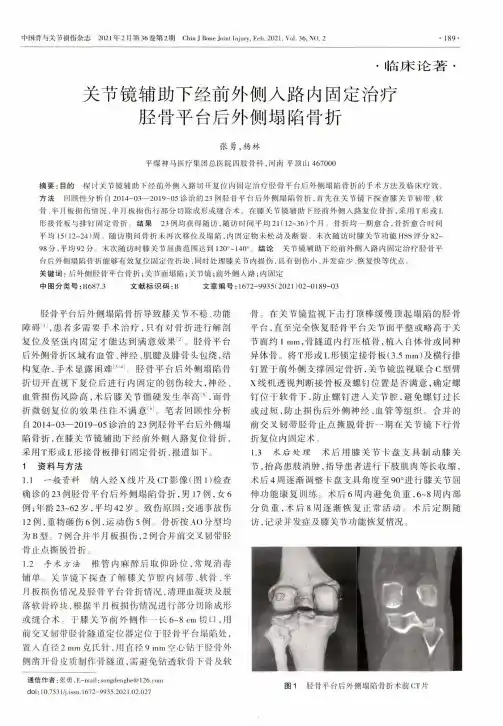 关节镜辅助下经前外侧入路内固定治疗胫骨平台后外侧塌陷骨折