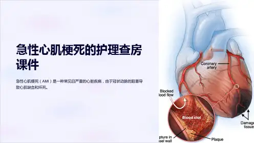 急性心肌梗死的护理查房课件