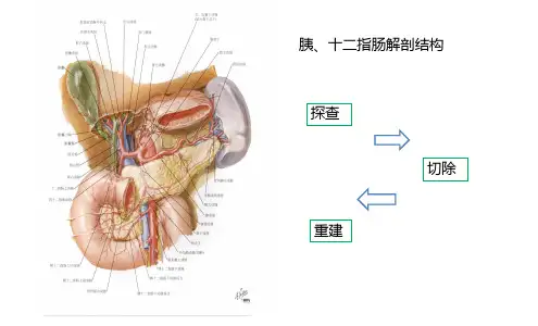 胰十二指肠切除术术式图解