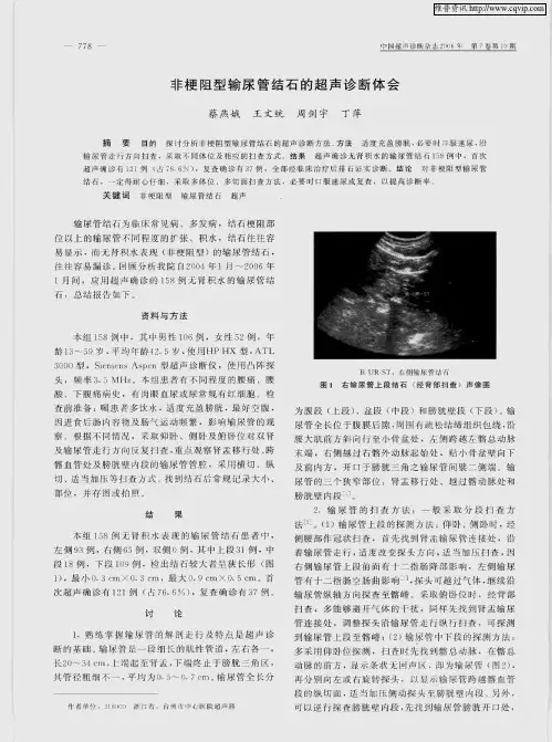 非梗阻型输尿管结石的超声诊断体会
