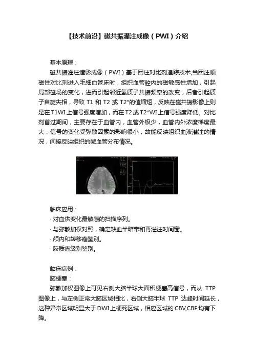 【技术前沿】磁共振灌注成像（PWI）介绍