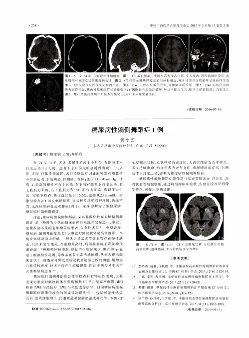 糖尿病性偏侧舞蹈症1例