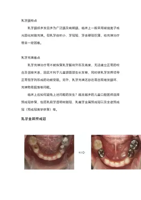 儿童乳牙预成冠详细讲解