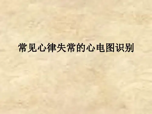 [医学]常见心律失常的心电图识别