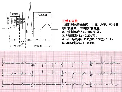 房室传导阻滞心电图的判读培训课件