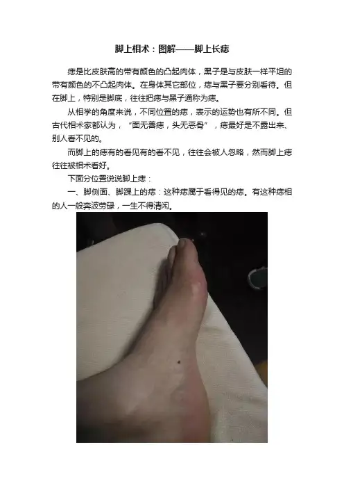脚上相术：图解——脚上长痣