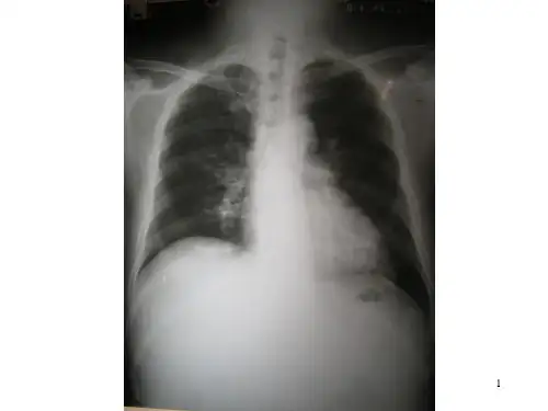 病毒性肺炎胸部CT片ppt课件