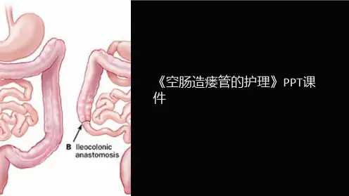 《空肠造瘘管的护理》课件
