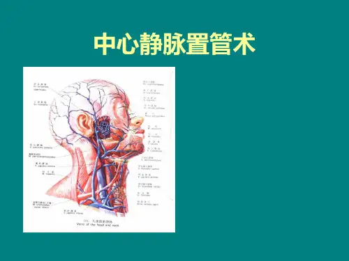 中心静脉置管术