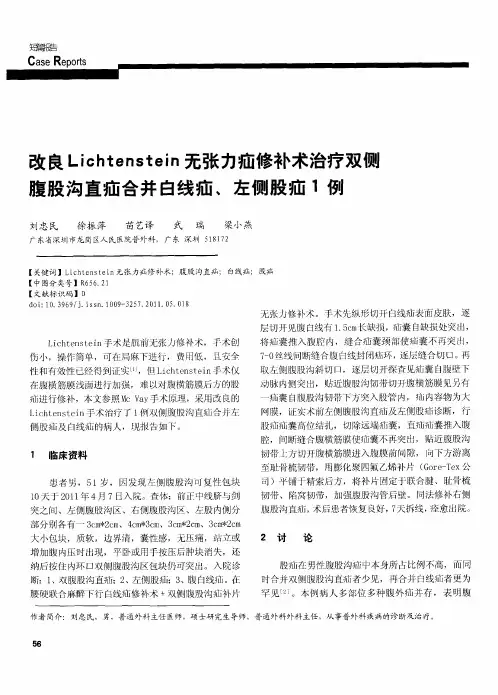 改良Lichtenstein无张力疝修补术治疗双侧腹股沟直疝合并白线疝、左侧股疝1例