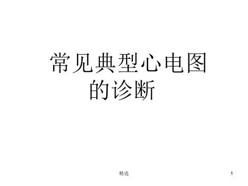 常见典型心电图诊断-规培
