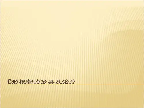 C形根管的分类及治疗
